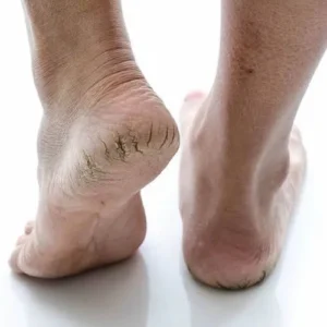 pe rachado fissura descamacao descamar homeopast tratamento para fissura pe ressecado hidratacao hidratante dicas de como tratar a fissura rachados rachadura Tratamentos Podológicos em Maringá