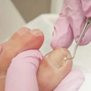 podologa para unhas encravadas Podóloga em Maringá