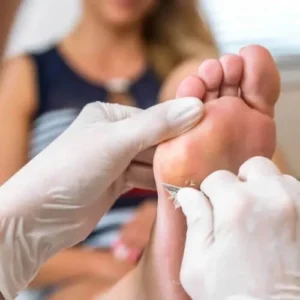 podologia calos calosidade dor no pe pe rachado pe ressecado Podóloga em Maringá