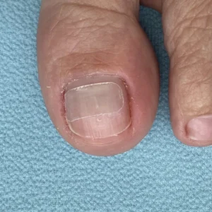 correcao curvatura unha maringa Tratamentos Podológicos em Maringá