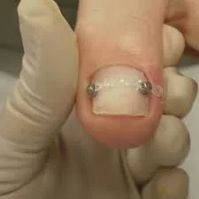 ortese ungueal podologia maringa Tratamentos Podológicos em Maringá