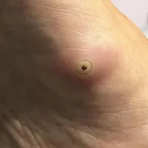 tratamento bicho de pe maringa Tratamentos Podológicos em Maringá