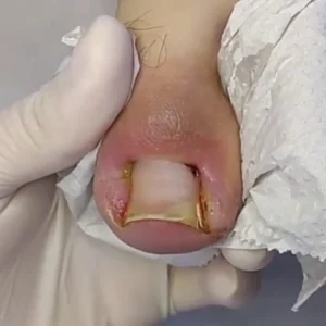 tratamento espiculaectomia maringa Podóloga em Maringá