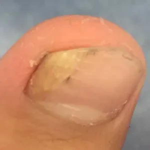 tratamento onicomicose maringa Podóloga em Maringá