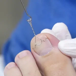 tratamento unha encravada maringa Tratamento de Unhas Encravadas em Maringá