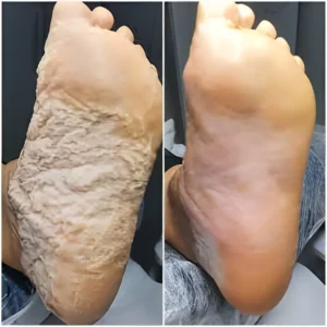 desbaste plantar maringa Tratamentos Podológicos em Maringá