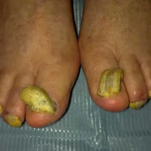 tratamento para onicogrifose unhas grossas em maringa Tratamentos Podológicos em Maringá